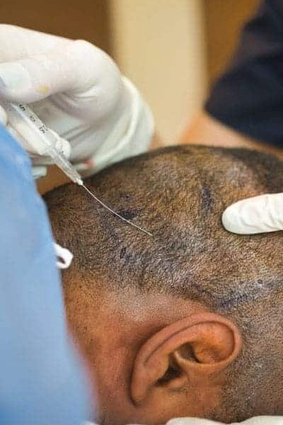 anestesia para implante capilar lotus ambulatory anesthesia solutions3